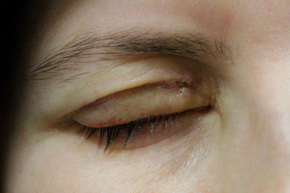 Göz kapağını kapatamayan hastalar altın implantla tedavi ediliyor